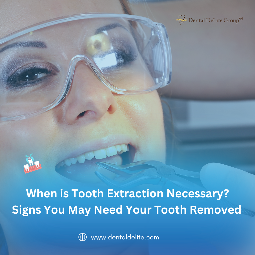 When is Tooth Extraction Necessary Signs You May Need Your Tooth Removed in Dallas and Duncanville, TX