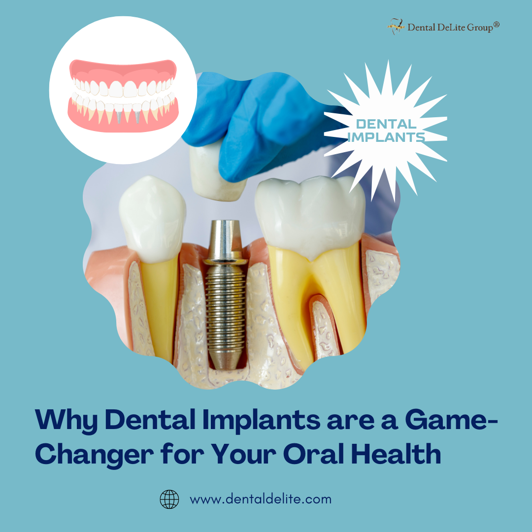 Why Dental Implants are a Game-Changer for Your Oral Health in Dallas and Duncanville, TX