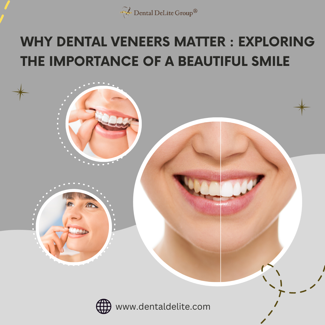 Why Dental Veneers Matter in Dallas, & Duncanville, TX: Exploring the Importance of a Beautiful Smile