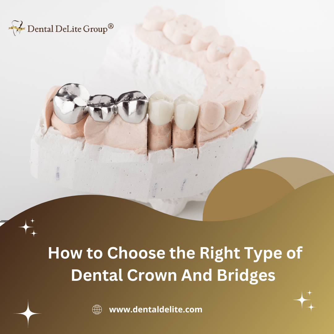 How to Choose the Right Type of Dental Crown And Bridges – Dallas & Duncanville, TX