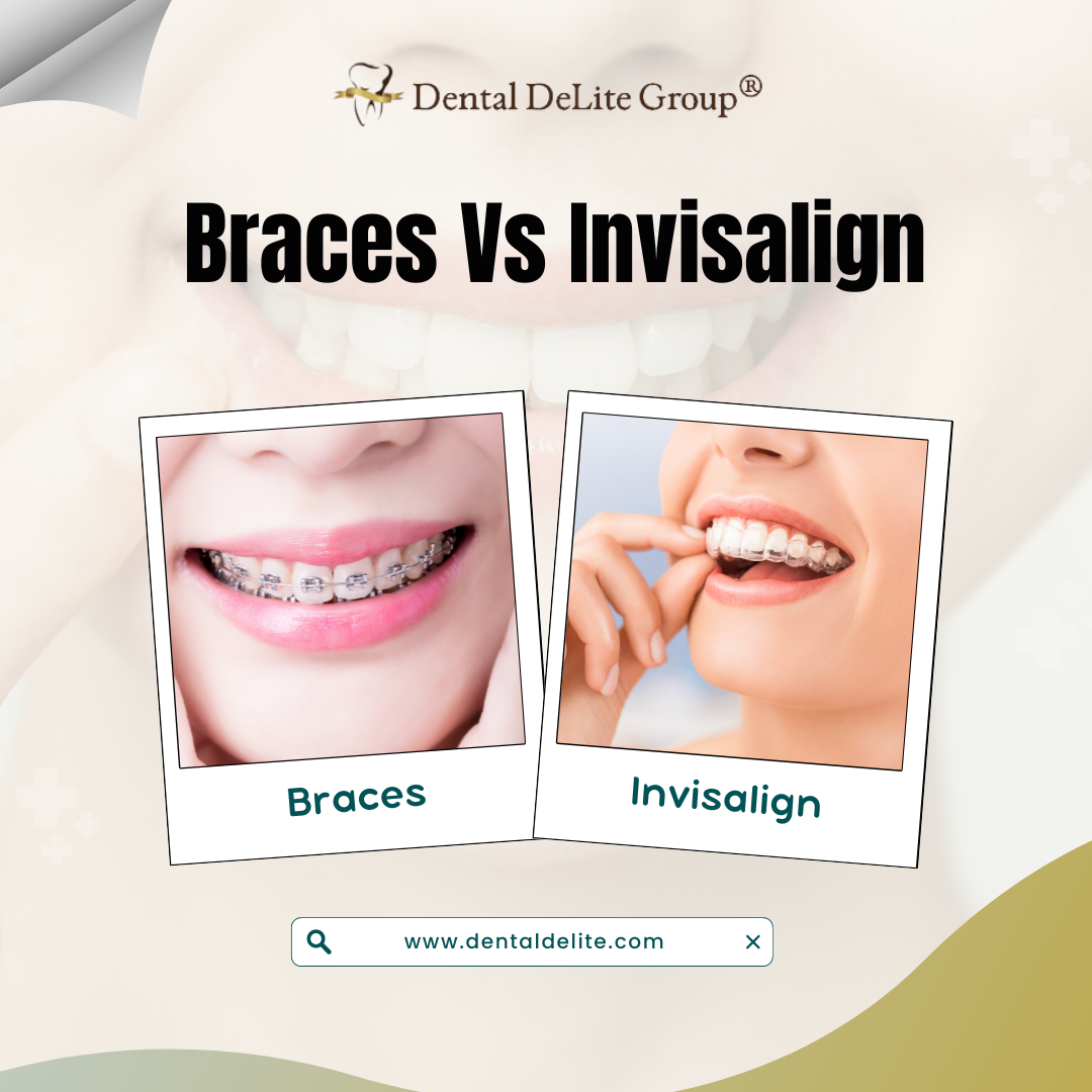 Braces Vs Invisalign in Dallas & Duncanville, TX: Making the Right Choice for Your Smile