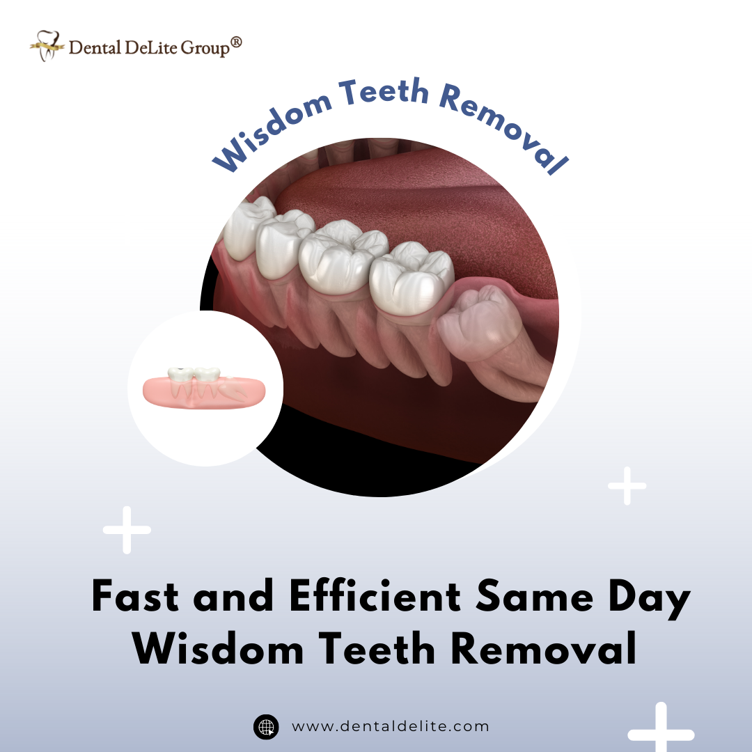 Fast and Efficient Same Day Wisdom Teeth Removal in Dallas & Duncanville, TX