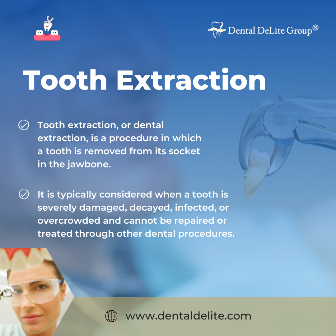 Tooth Extraction in Dallas & Duncanville, TX 