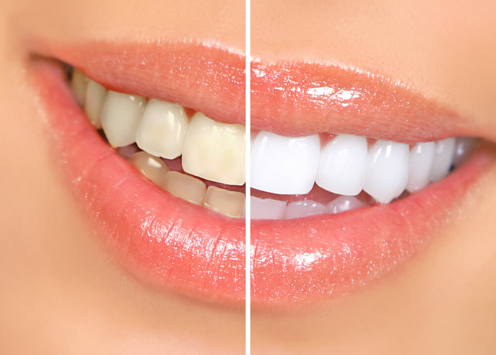 teeth whitening concept