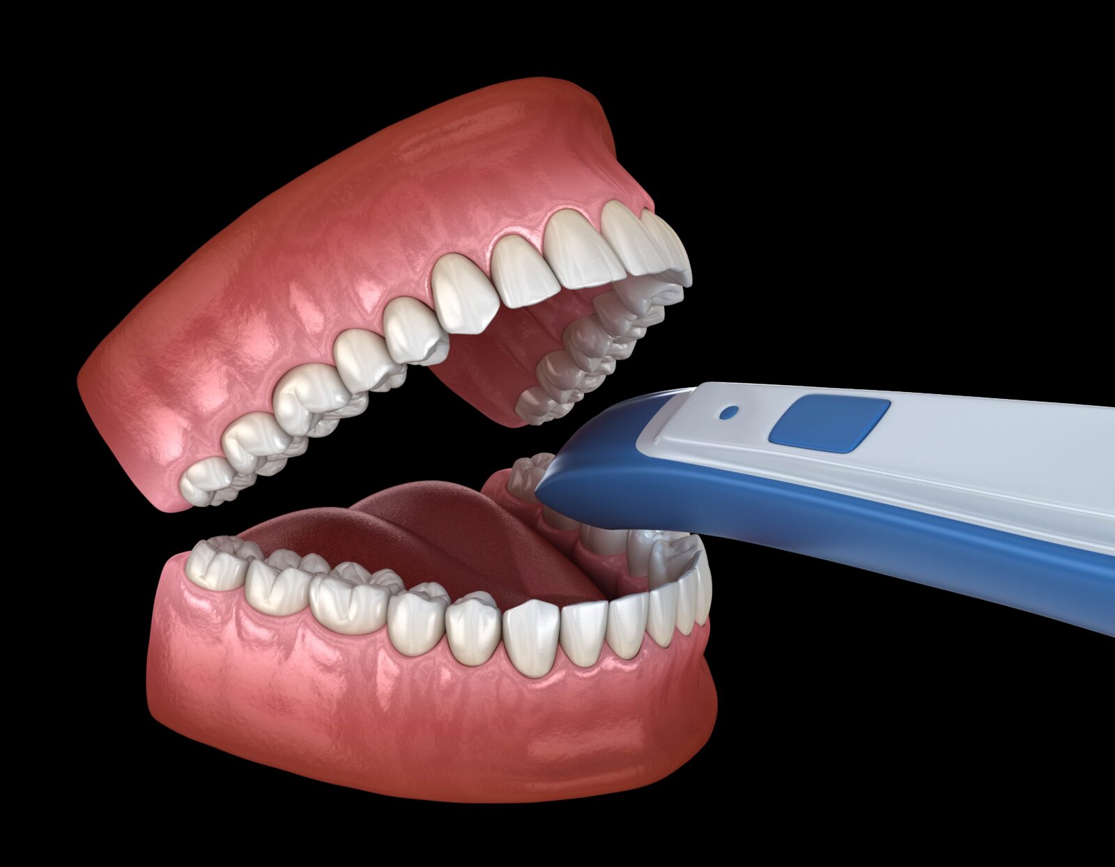 how an intraoral scan is performed