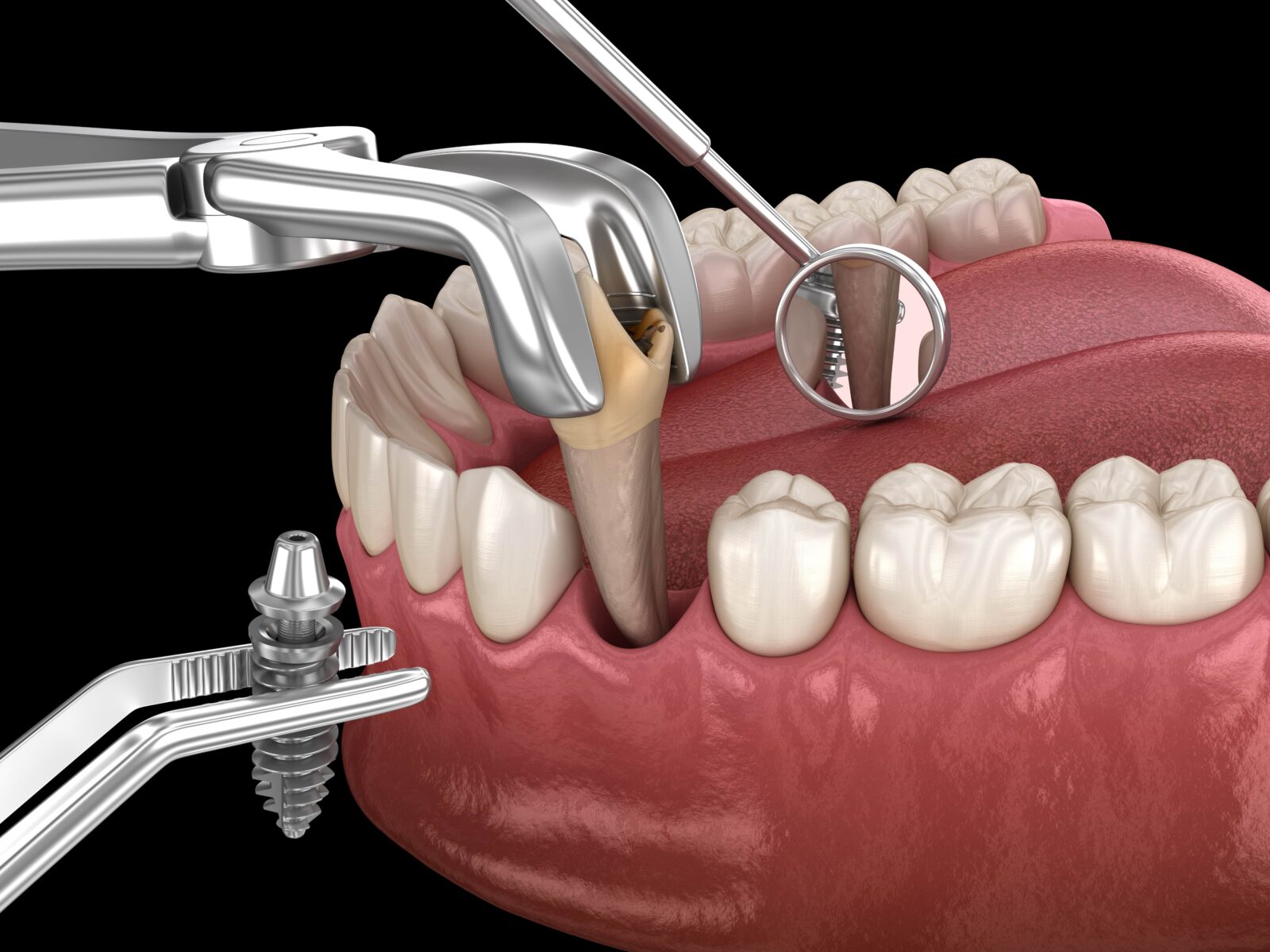 tooth being extracted and implant being placed