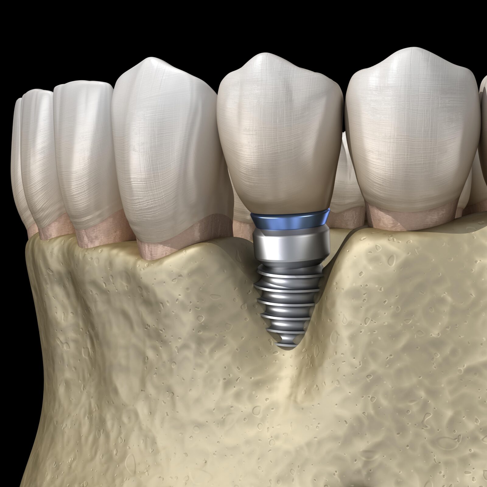 bone loss around dental implant