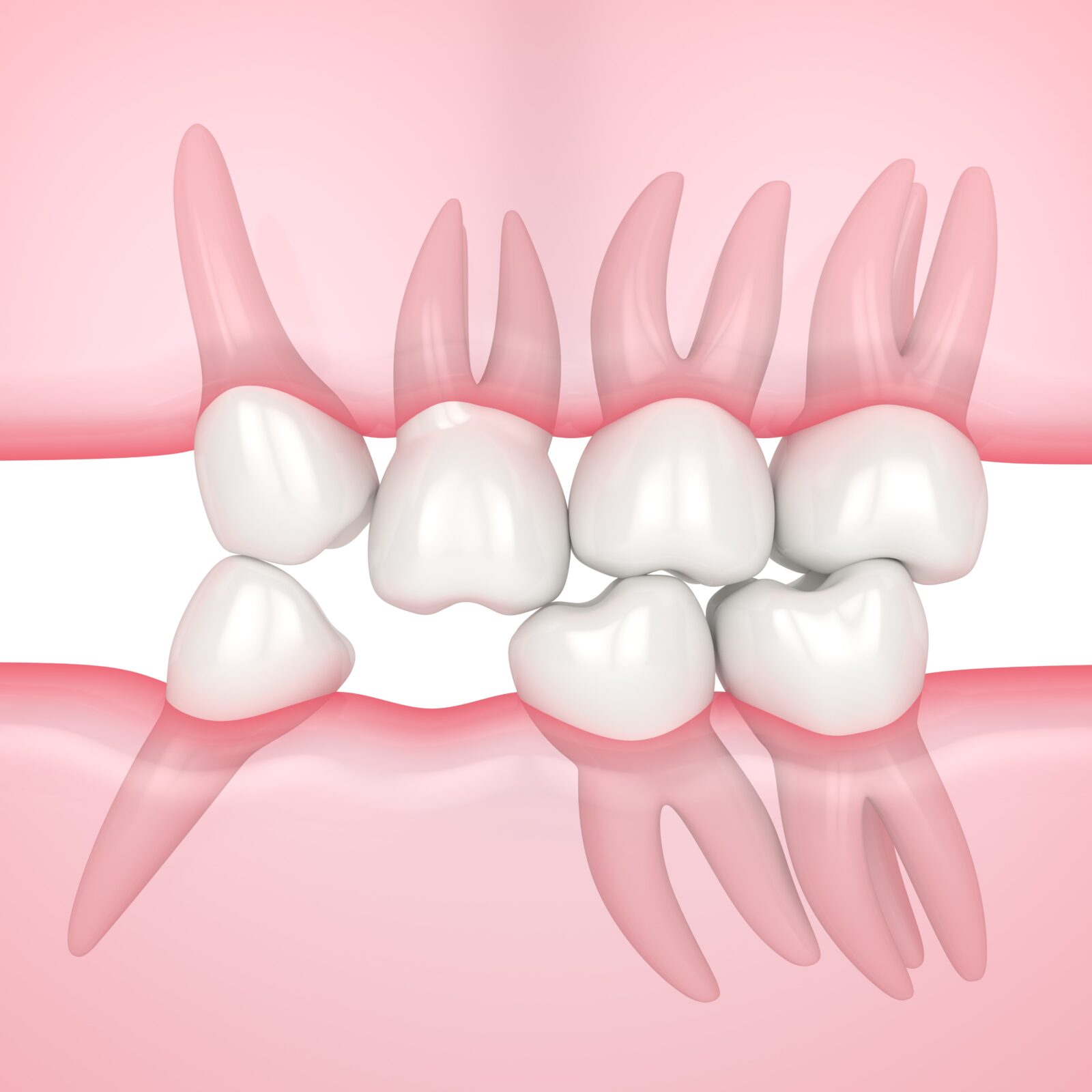 alignment problems due to a missing tooth