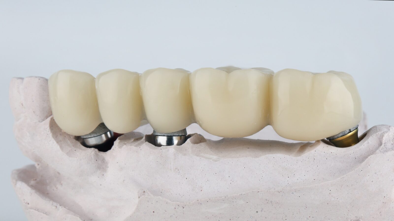 long dental bridge with three implants