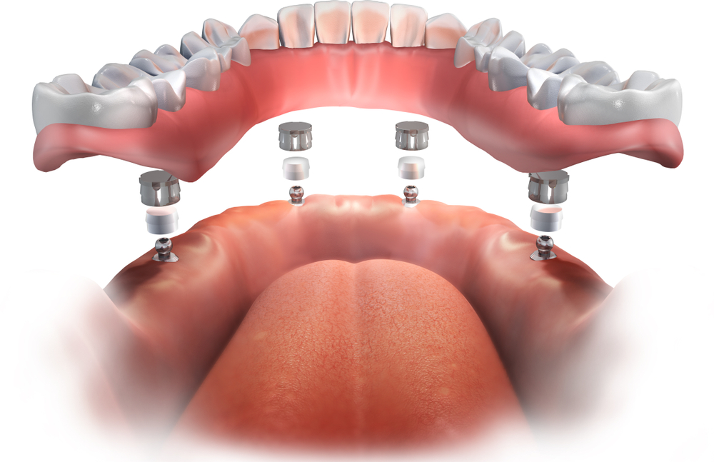 Implant-Supported Dentures all on 4