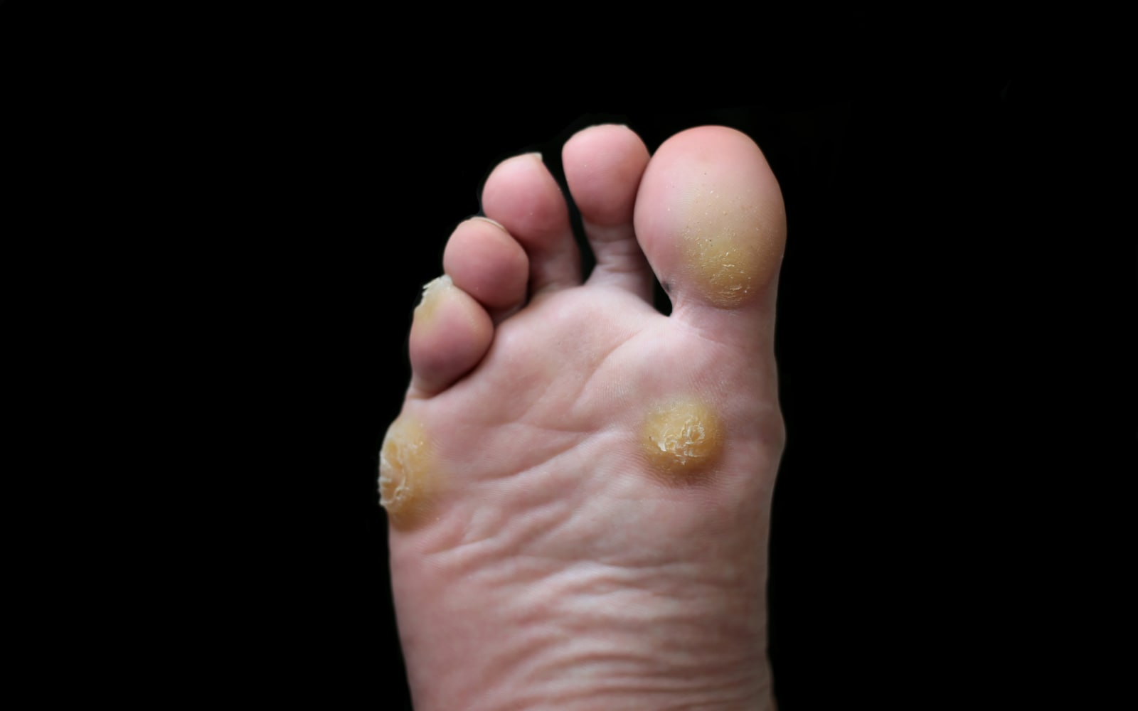 A foot with prominent corns