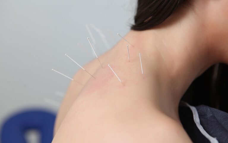 Woman Getting Acupuncture in the Neck Area