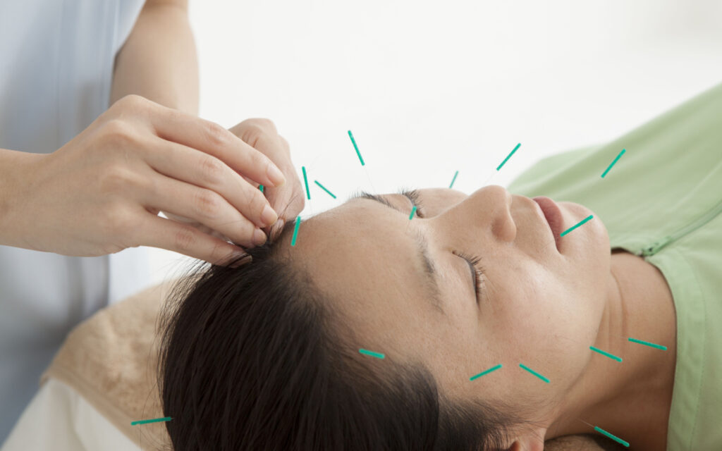 Acupuncture for easing stress and aiding sleep