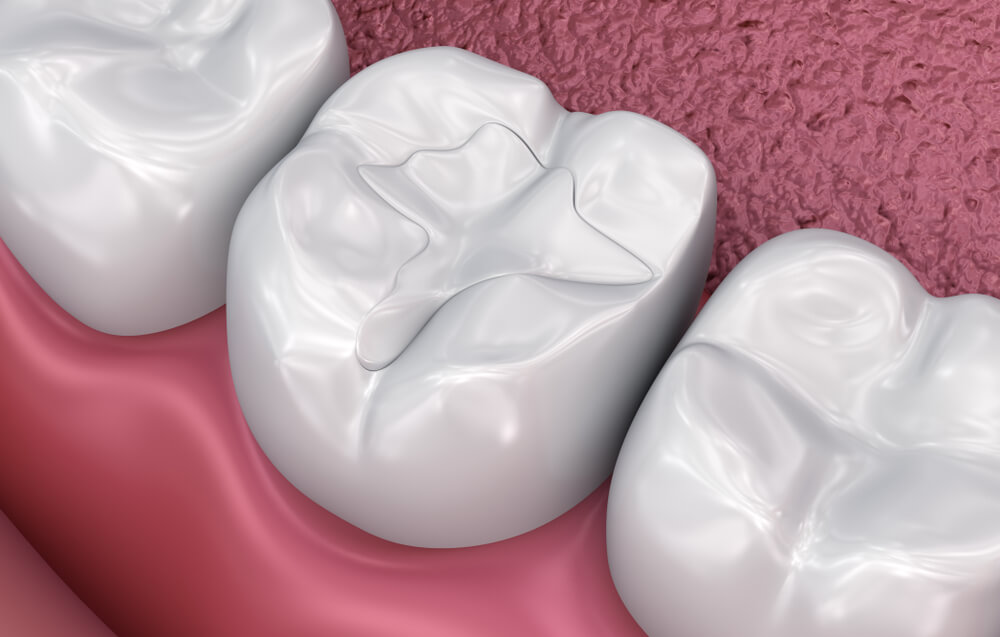 Composite tooth colored fillings showing the concept of Services