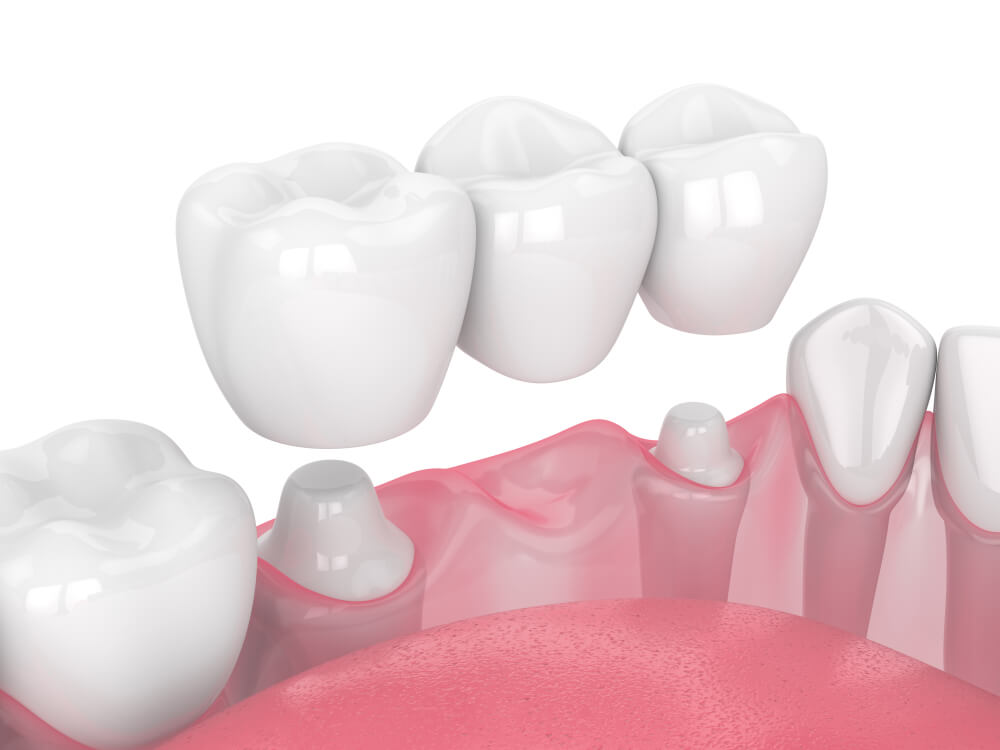 shutterstock 1535474549 showing the concept of Crowns and Bridges
