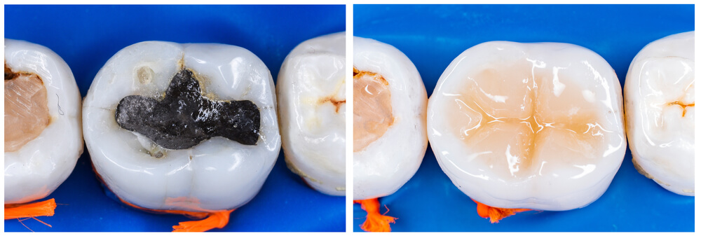 shutterstock 1854590944 showing the concept of Composite Tooth-Colored Fillings