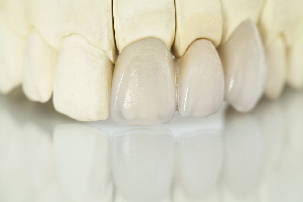 shutterstock 401263708 showing the concept of CEREC® Same-Day Crowns & Veneers