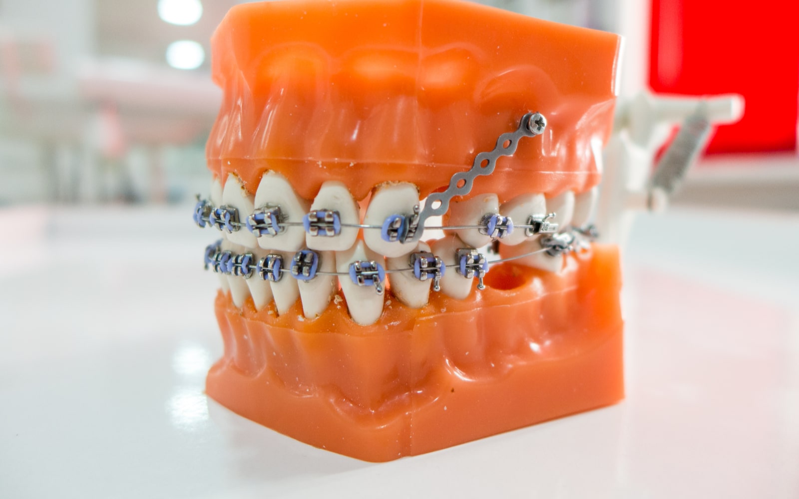 Orthodontic Anchorage Control Model