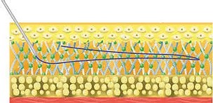 Vsoft smooth dermis