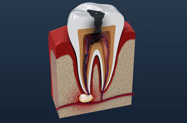 root showing the concept of How Do I Know if I Need a Root Canal?