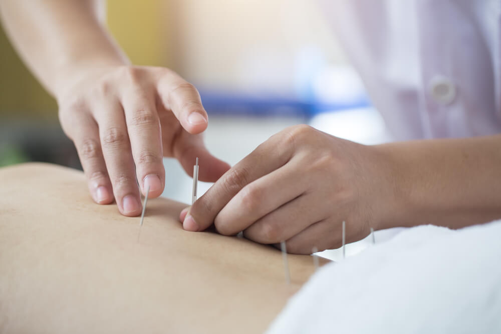 Acupuncture Therapy treatment