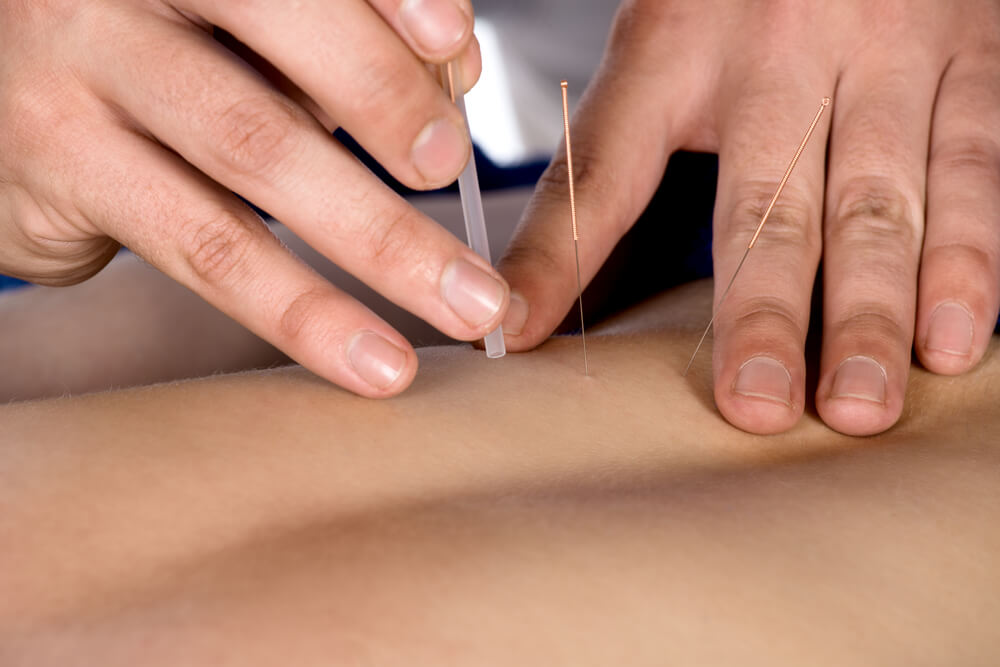 Acupuncture Therapy Treatment