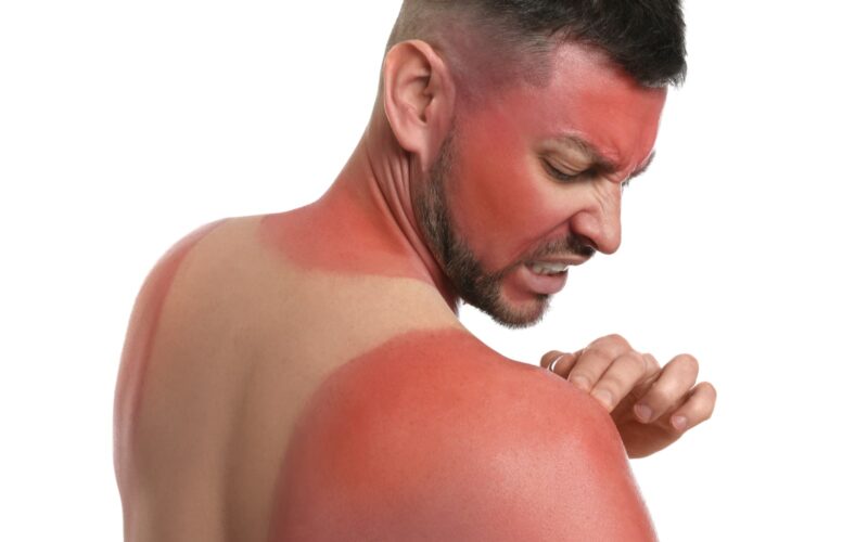 Man with serious sunburn