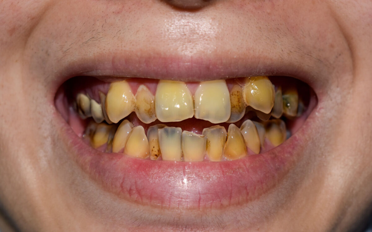 Teeth with dental stains and early cavities