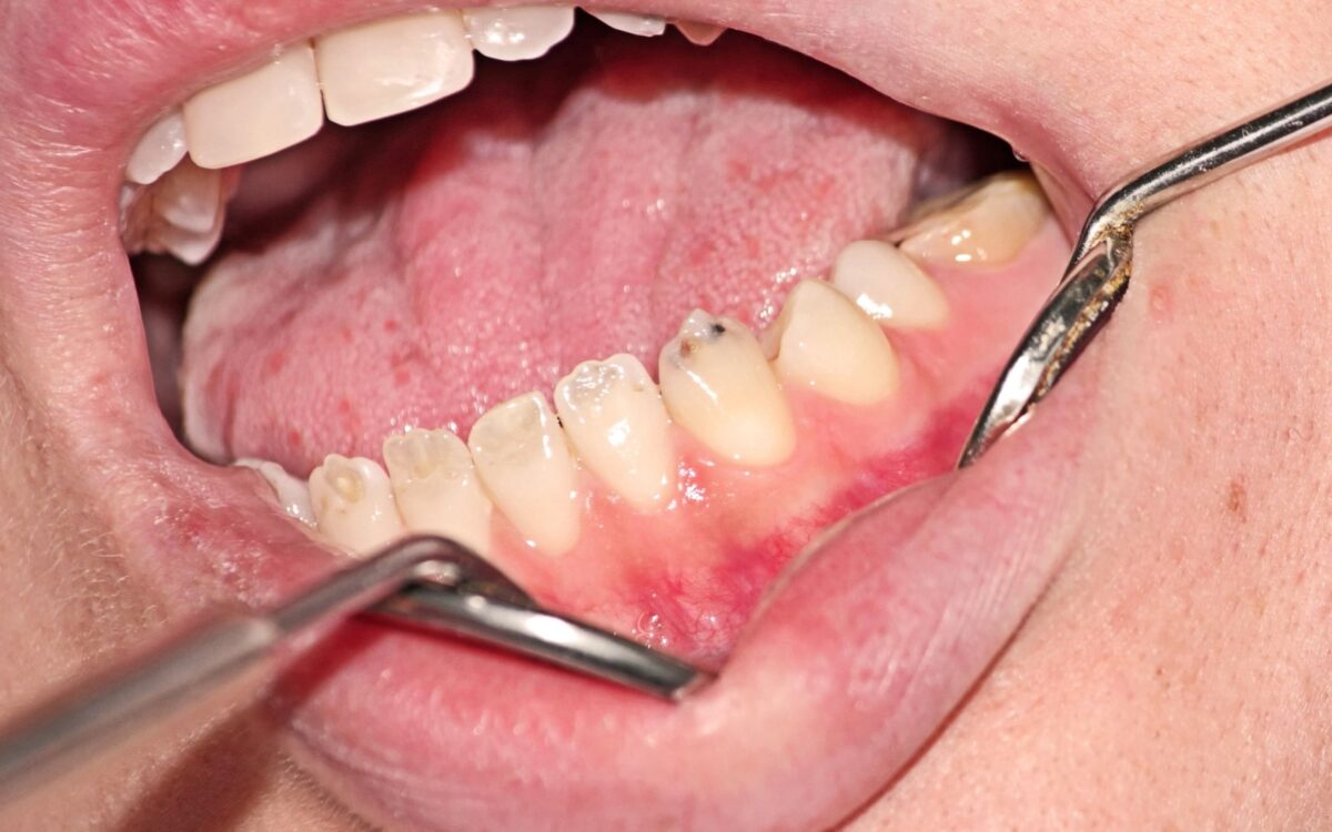 Decaying enamel due to dentinogenesis imperfecta