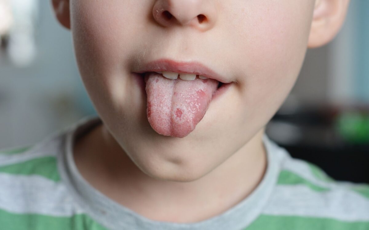 Child with oral lichen planus