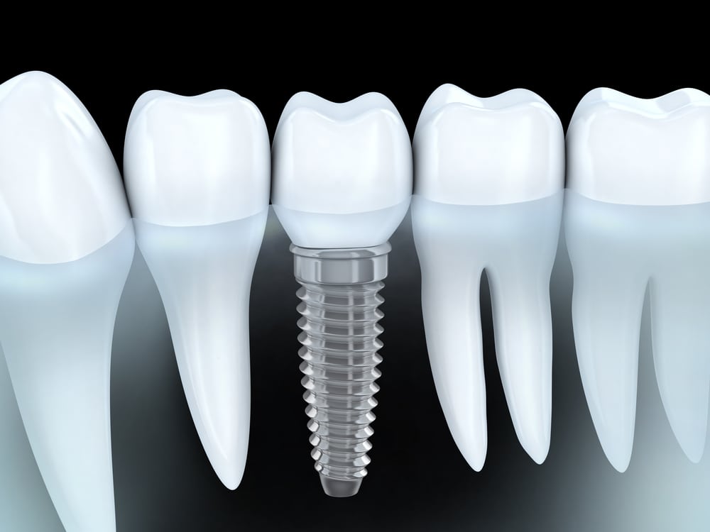 Dental Implants showing the concept of Home