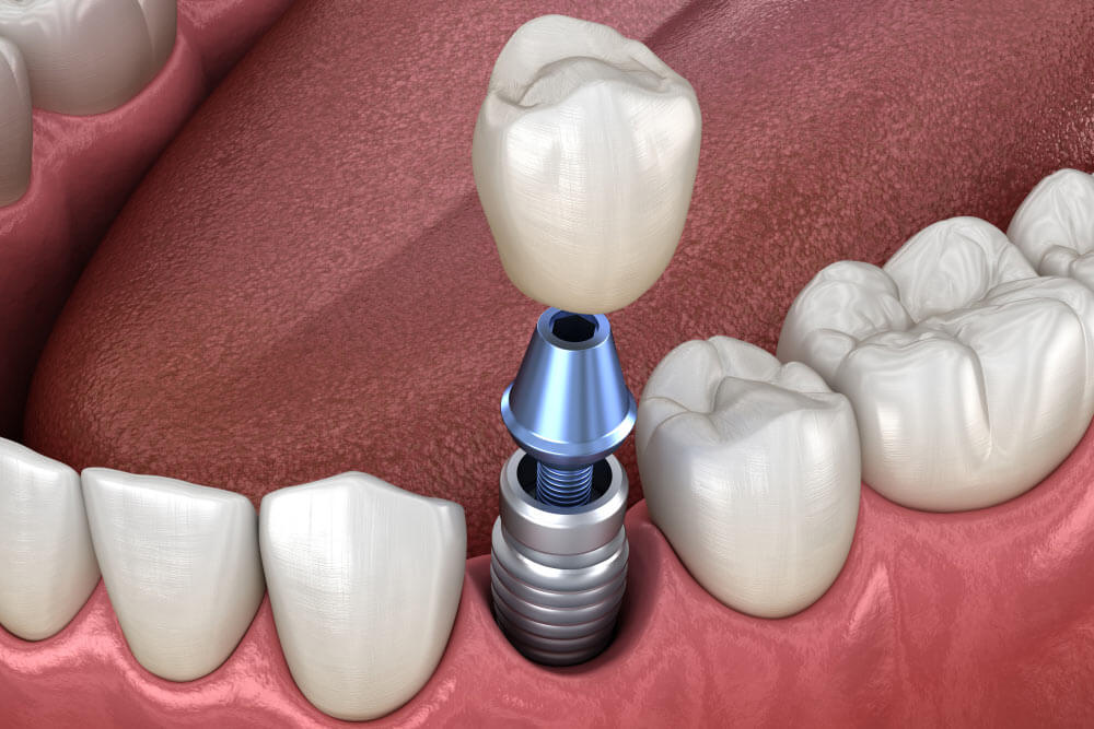 Dental implants showing the concept of Procedures