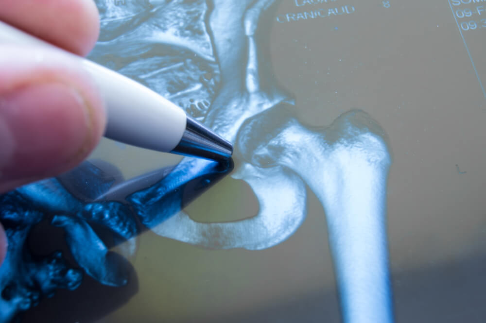 Hip Arthroscopy showing the concept of Treatments