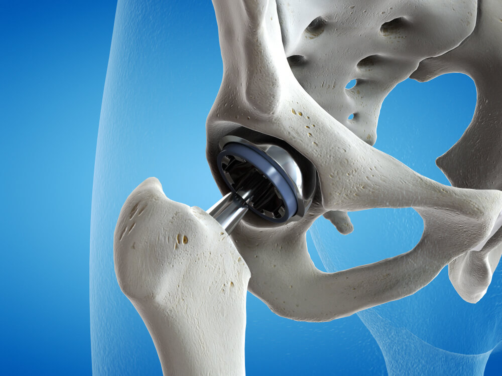 Hip Replacement showing the concept of Treatments