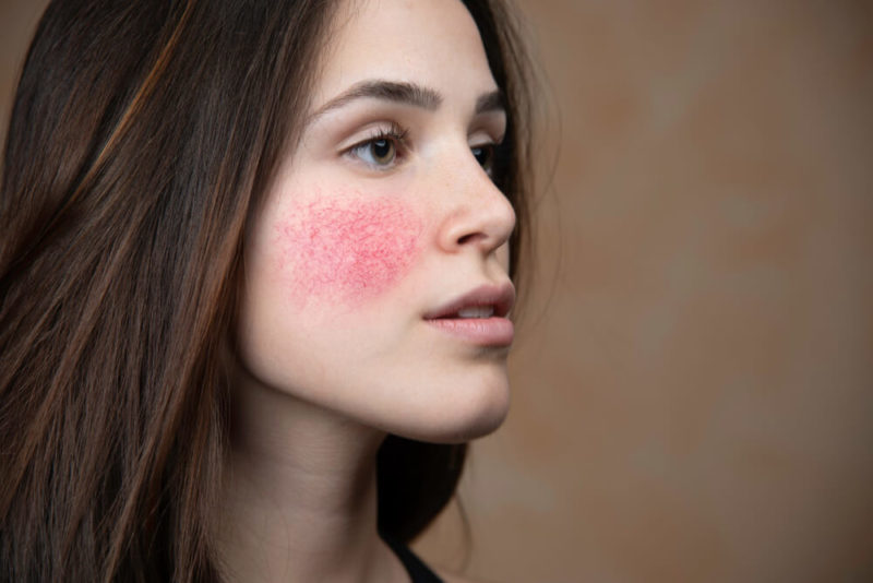 Rosacea ft img showing the concept of Medical & Surgical Dermatology