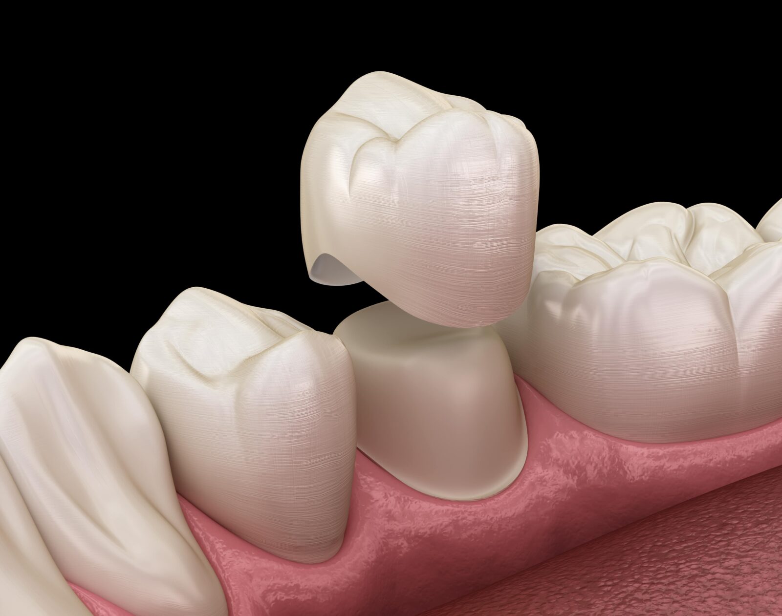 dental crown on tooth