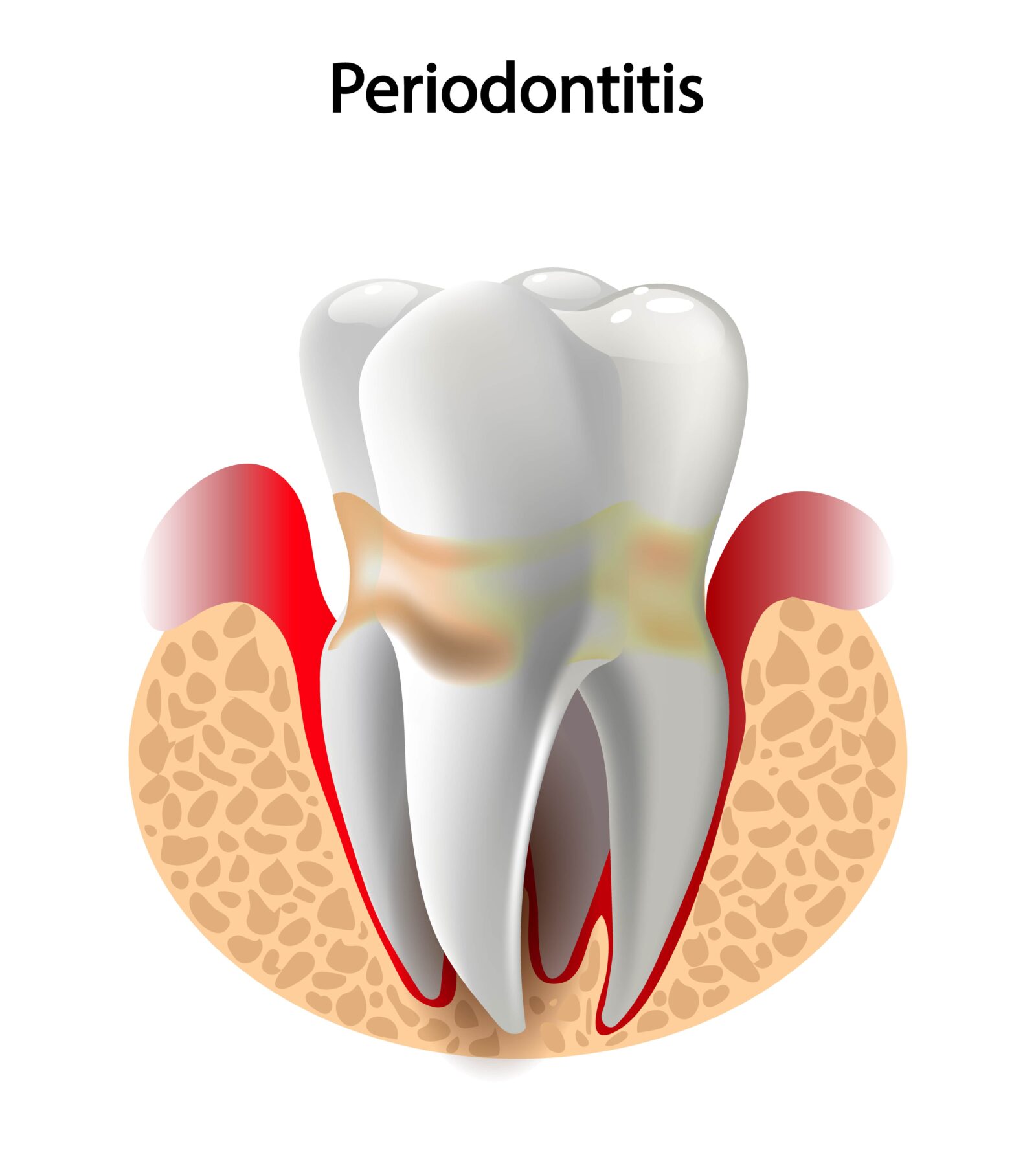 periodontal pockets