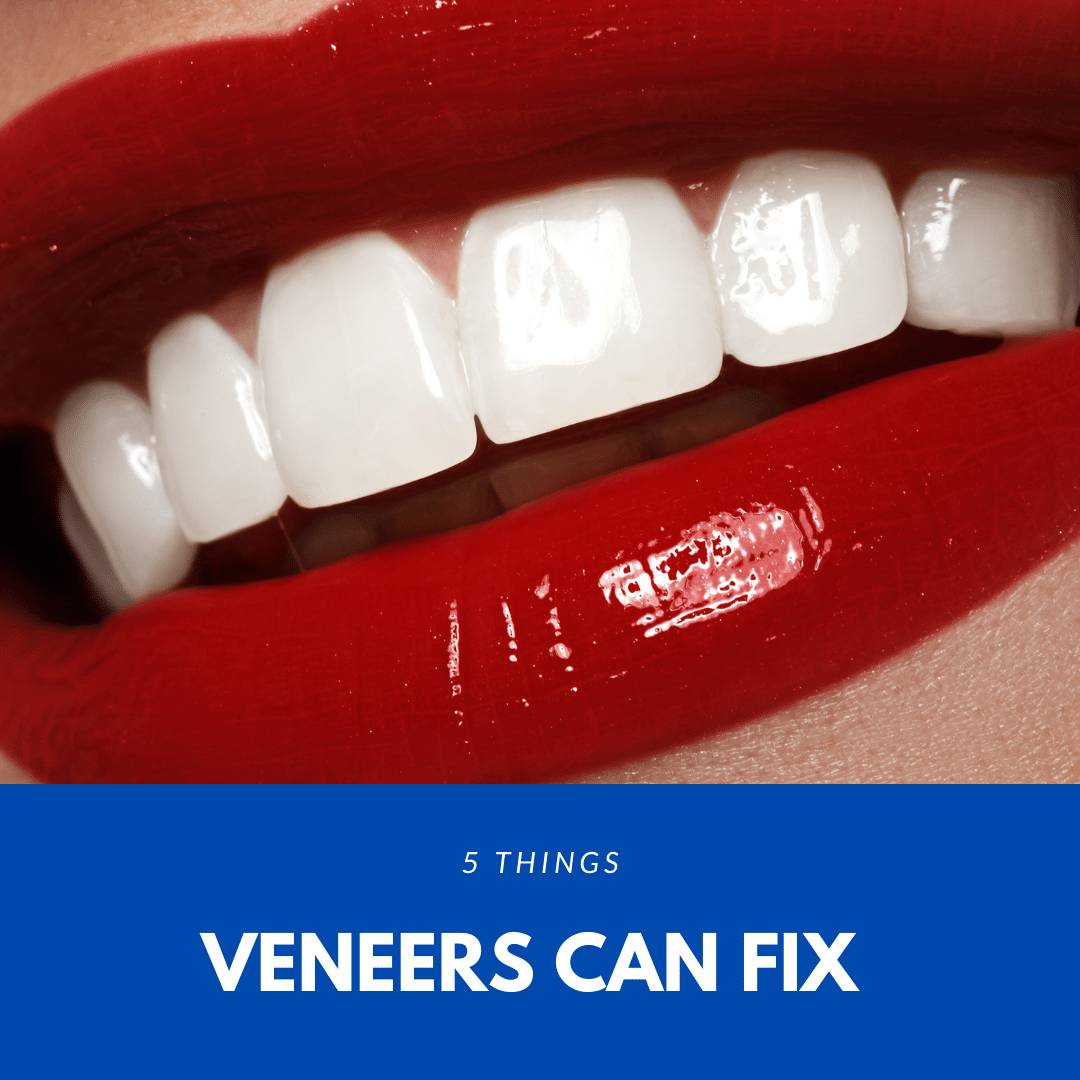 5 things veneers can fix