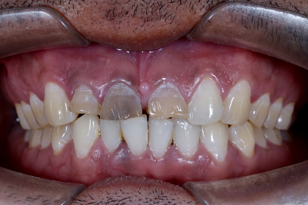 a single discolored tooth