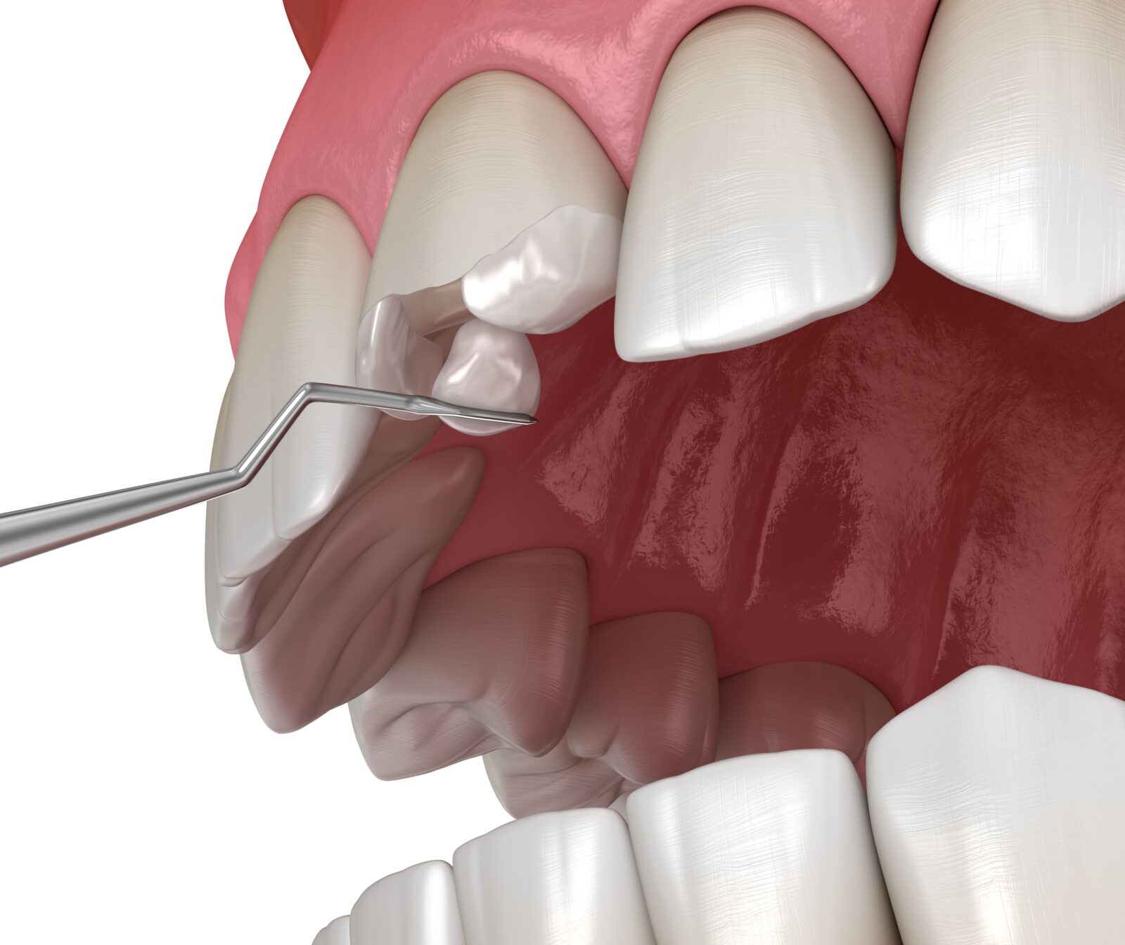 dental composite being used to repair broken tooth