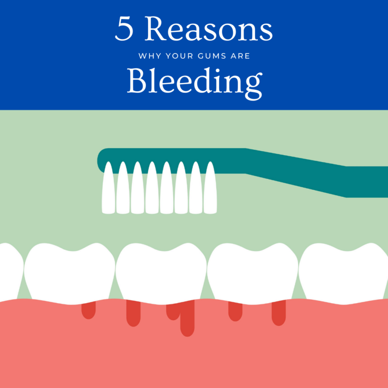 5 Reasons why gums bleedg