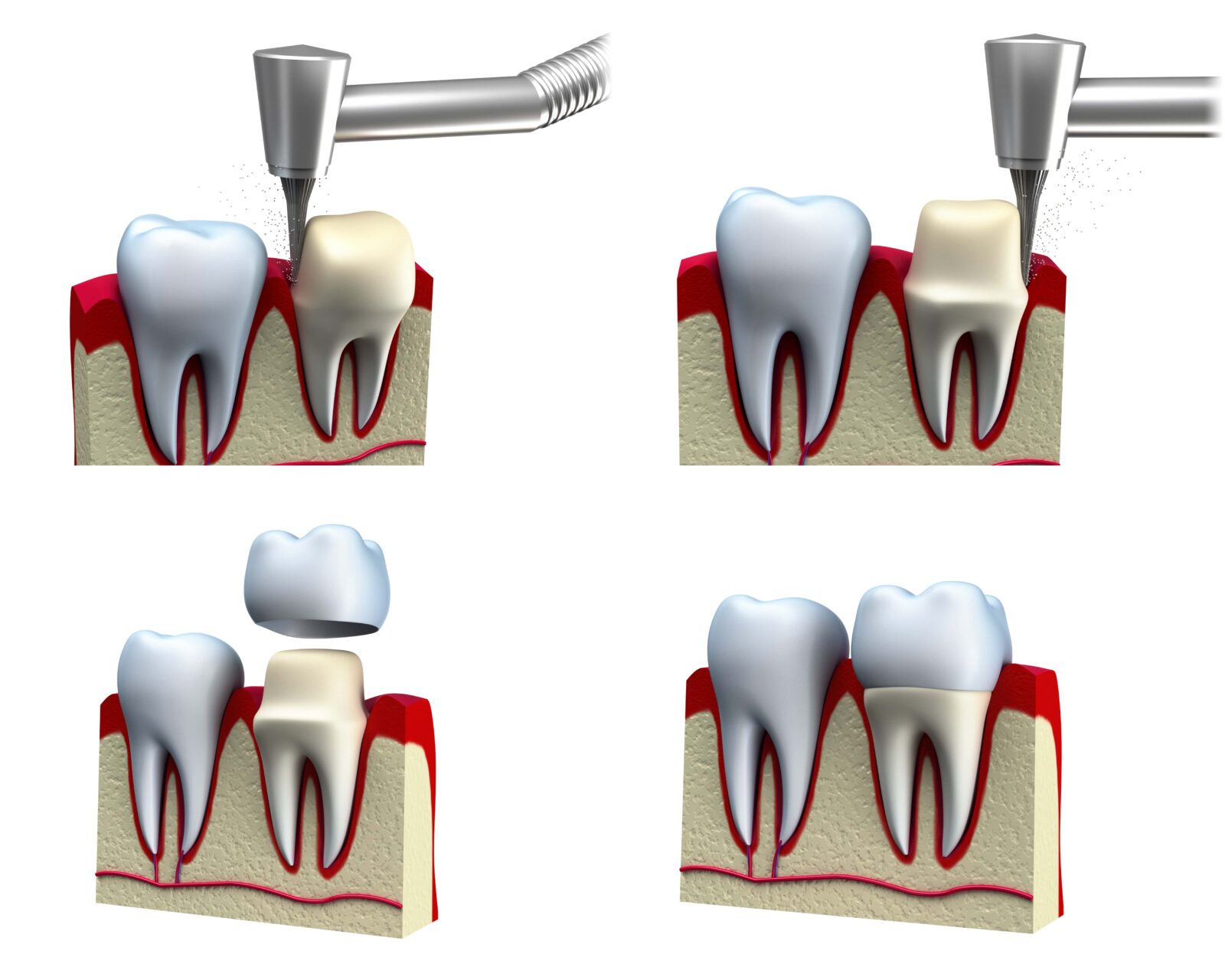 dental crown placement process