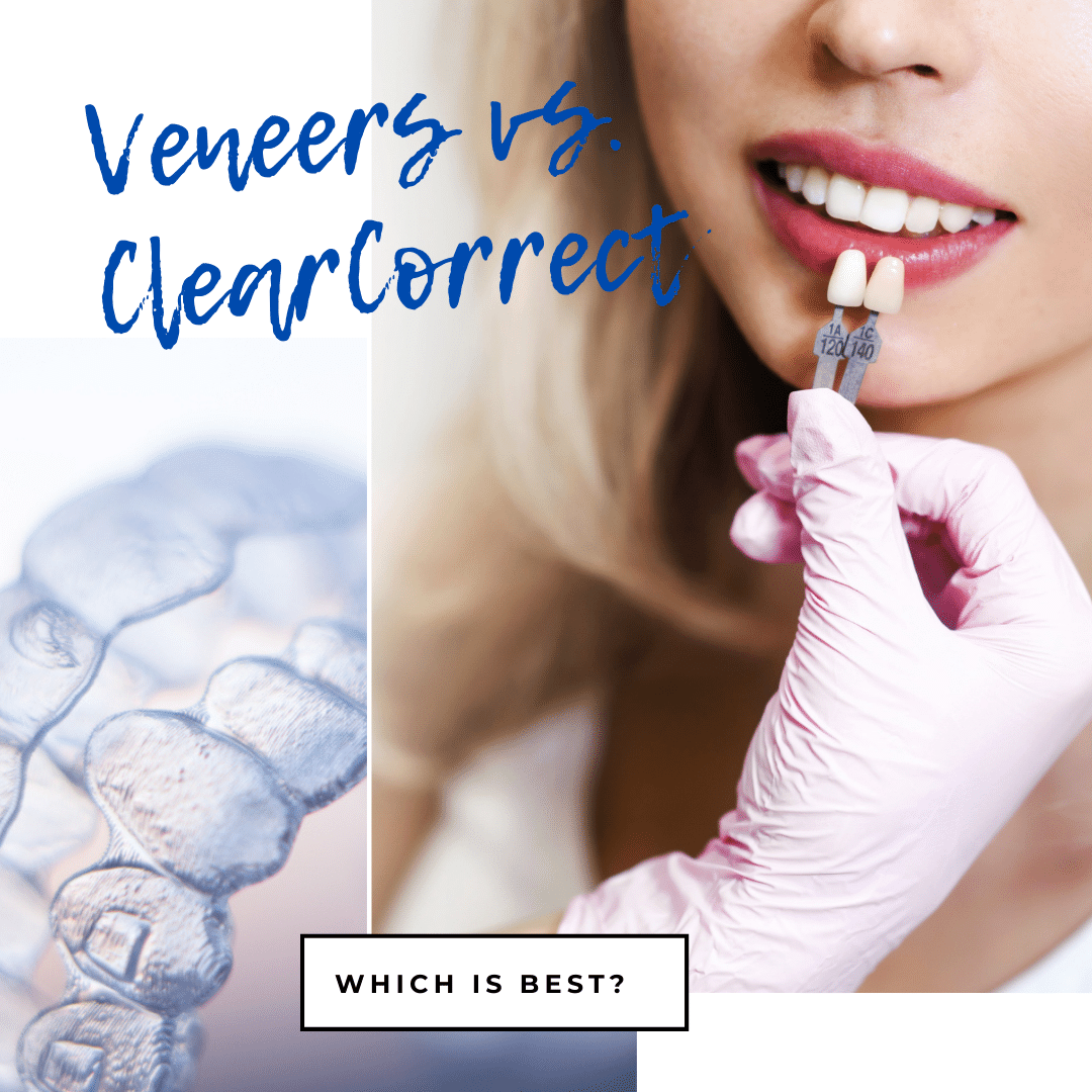 Veneers vs. Invisalign (1)