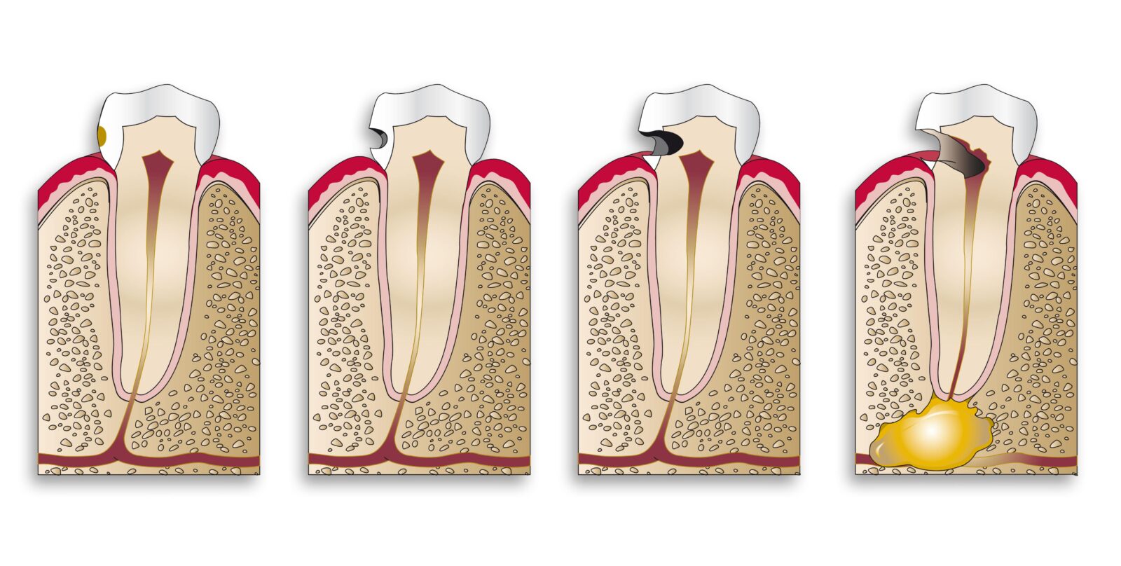 stages of cavity formation