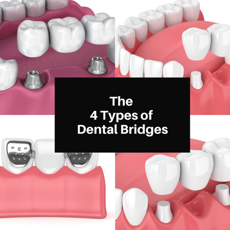 The 4 Types of Dental Bridges