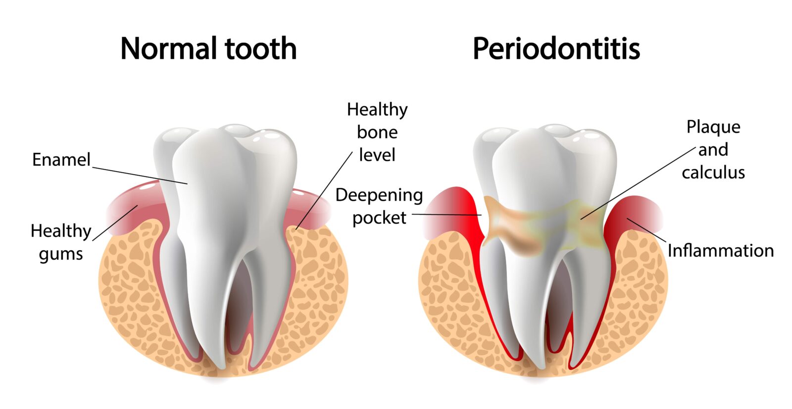 normal tooth vs. periodontitis