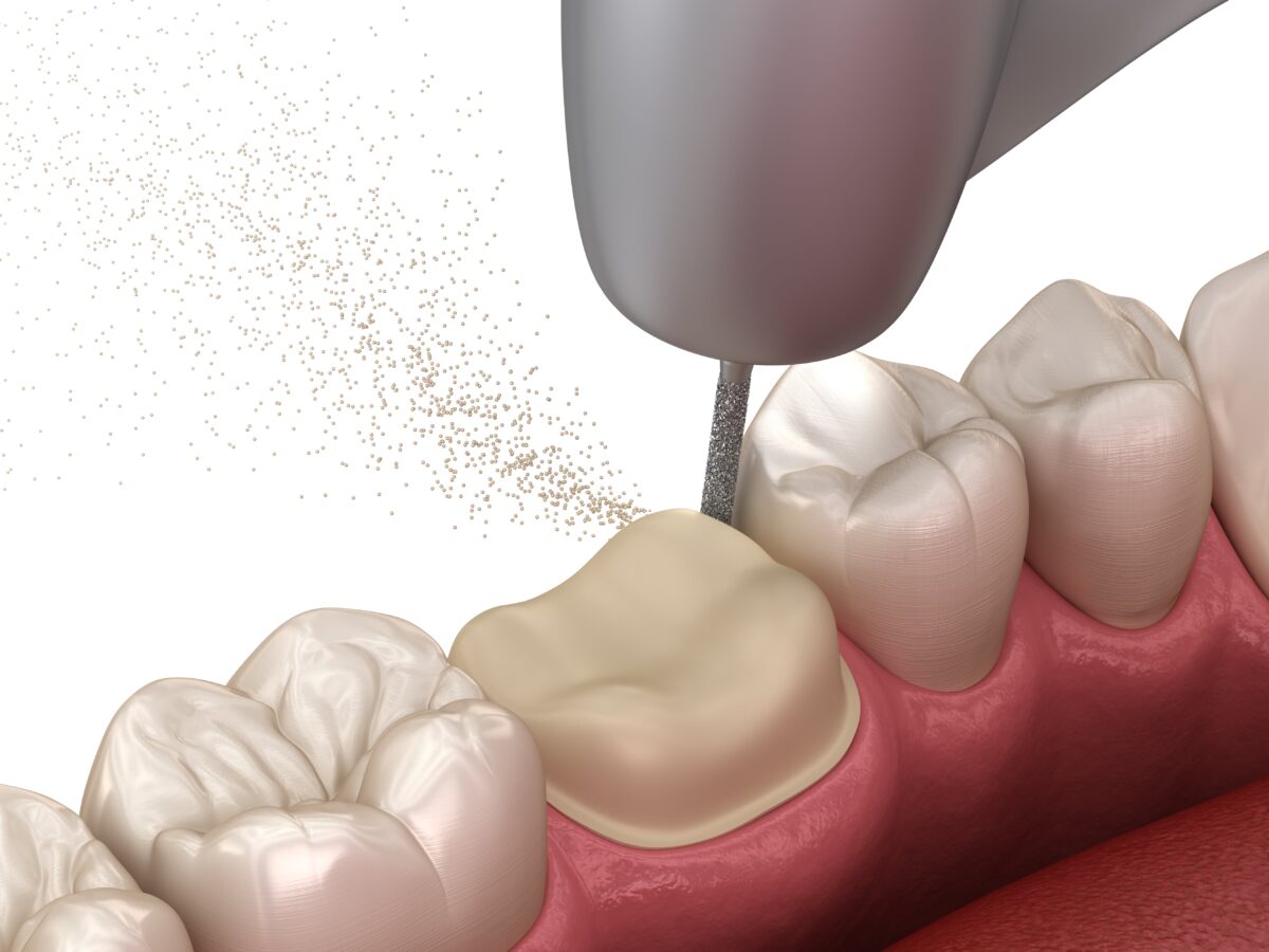How Much Tooth is Needed for a Crown? Raleigh, NC Sedation Dental