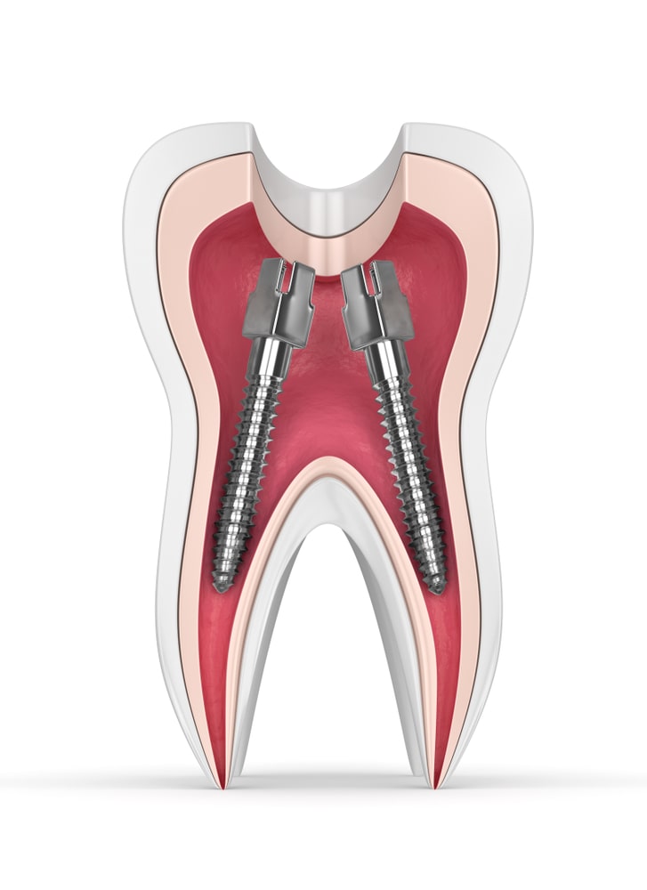 posts inside a tooth