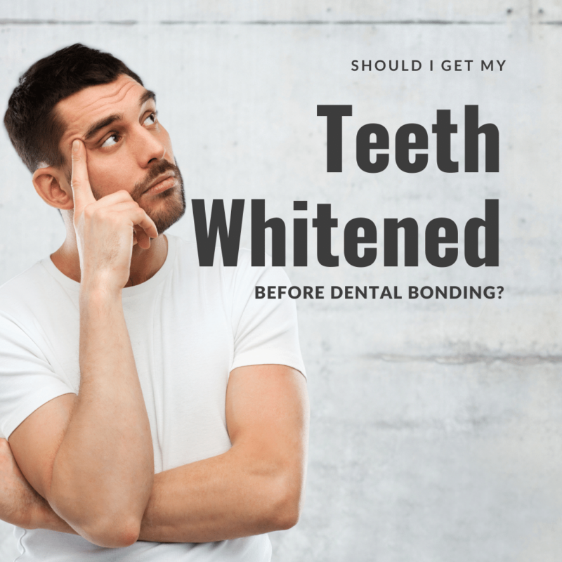 Should I Get my Teeth Whitened Before Dental Bonding