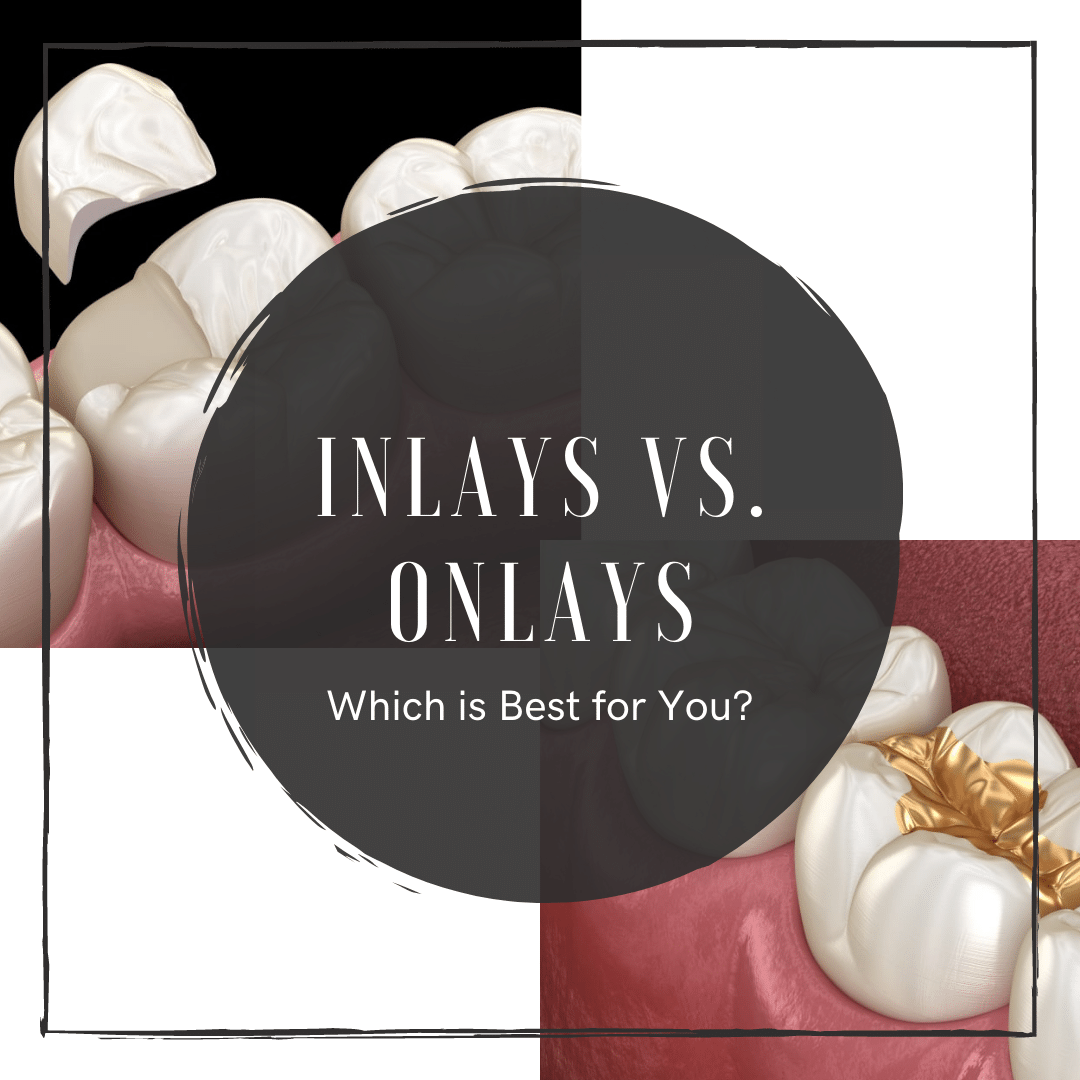 Inlays and Onlays Which is best for you